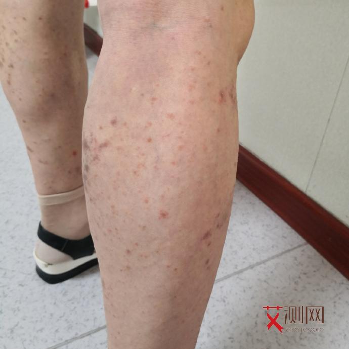 艾滋病潜伏期一般是多少年?