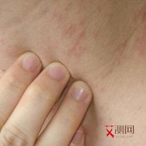 艾滋初期什么样子图片