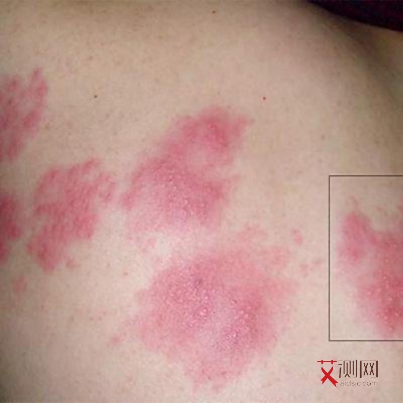 艾滋病身上会出现小红点吗会痒吗