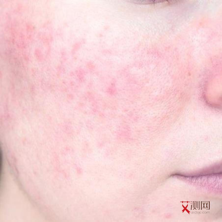 艾滋病征兆是什么表现呢