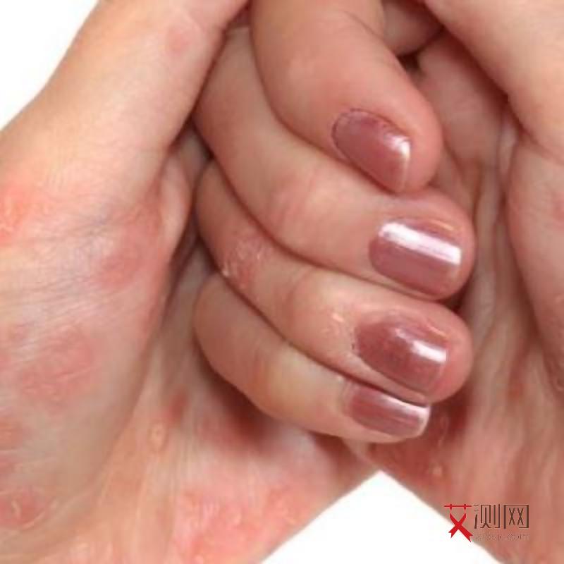 艾滋病皮肤溃烂会传染吗女性症状表现是什么