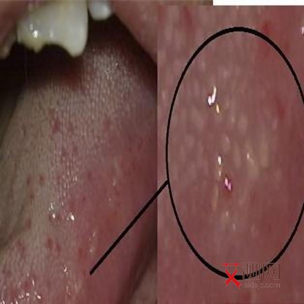 艾滋病的表现是什么症状图片大全图解