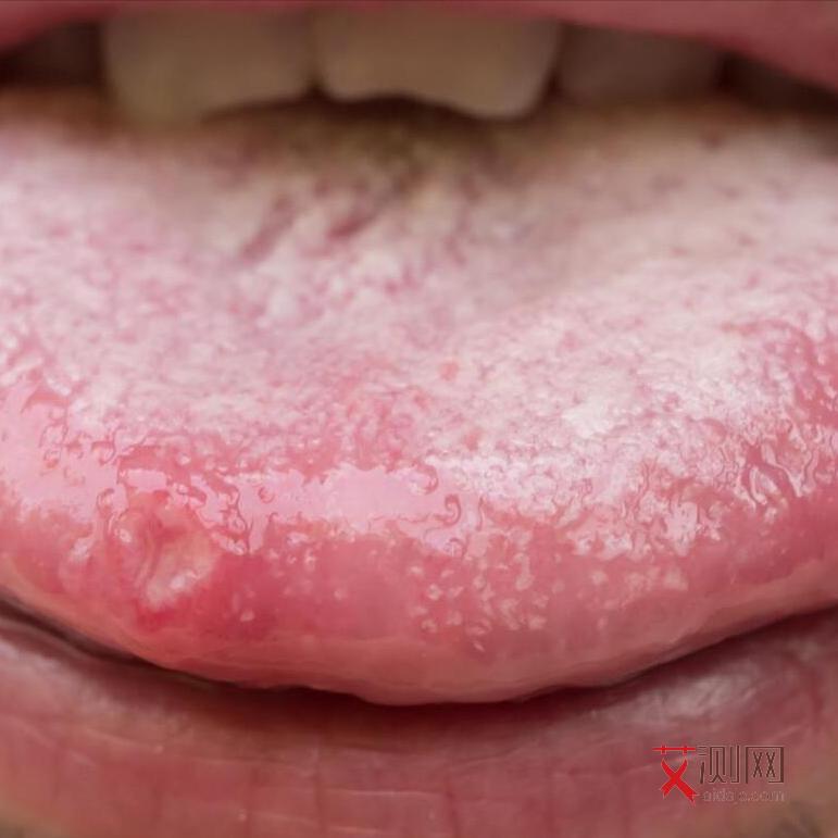 艾滋病女性多久有症状啊图片大全图解