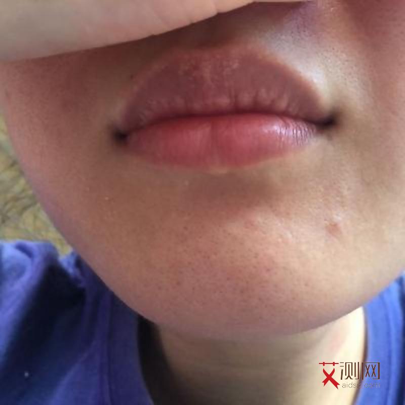 艾滋病嘴唇内侧起白皮图片真实
