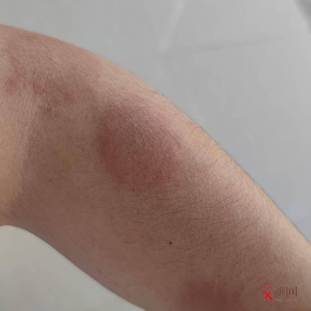 艾滋病出现皮疹会有其他并发症吗