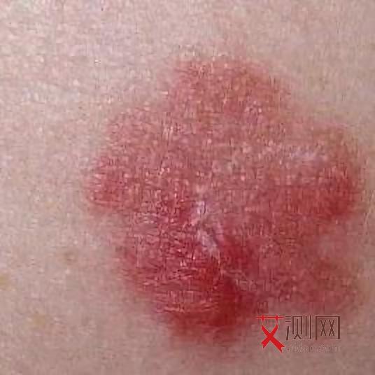 男艾滋病的症状是什么样子图片