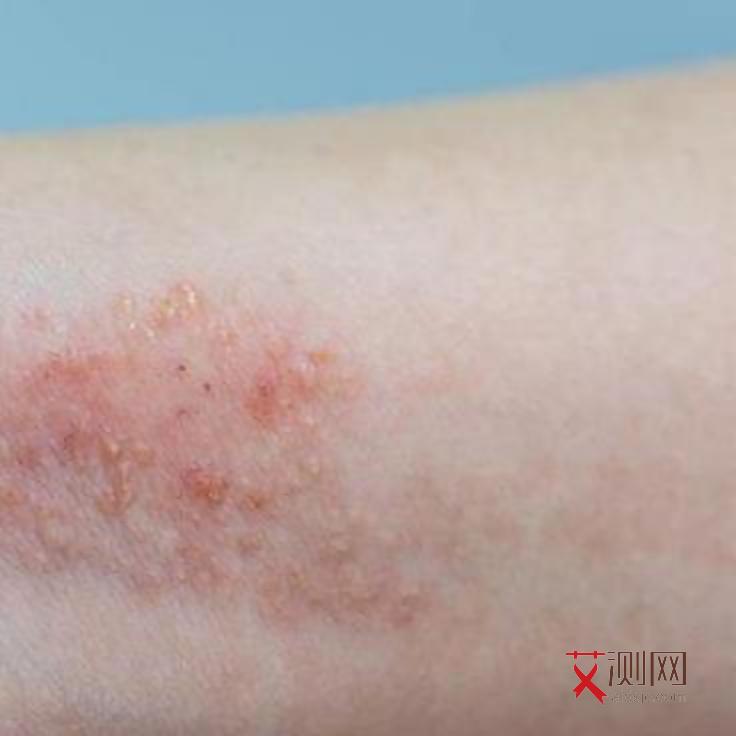 艾滋病什么症状表现男性女性多