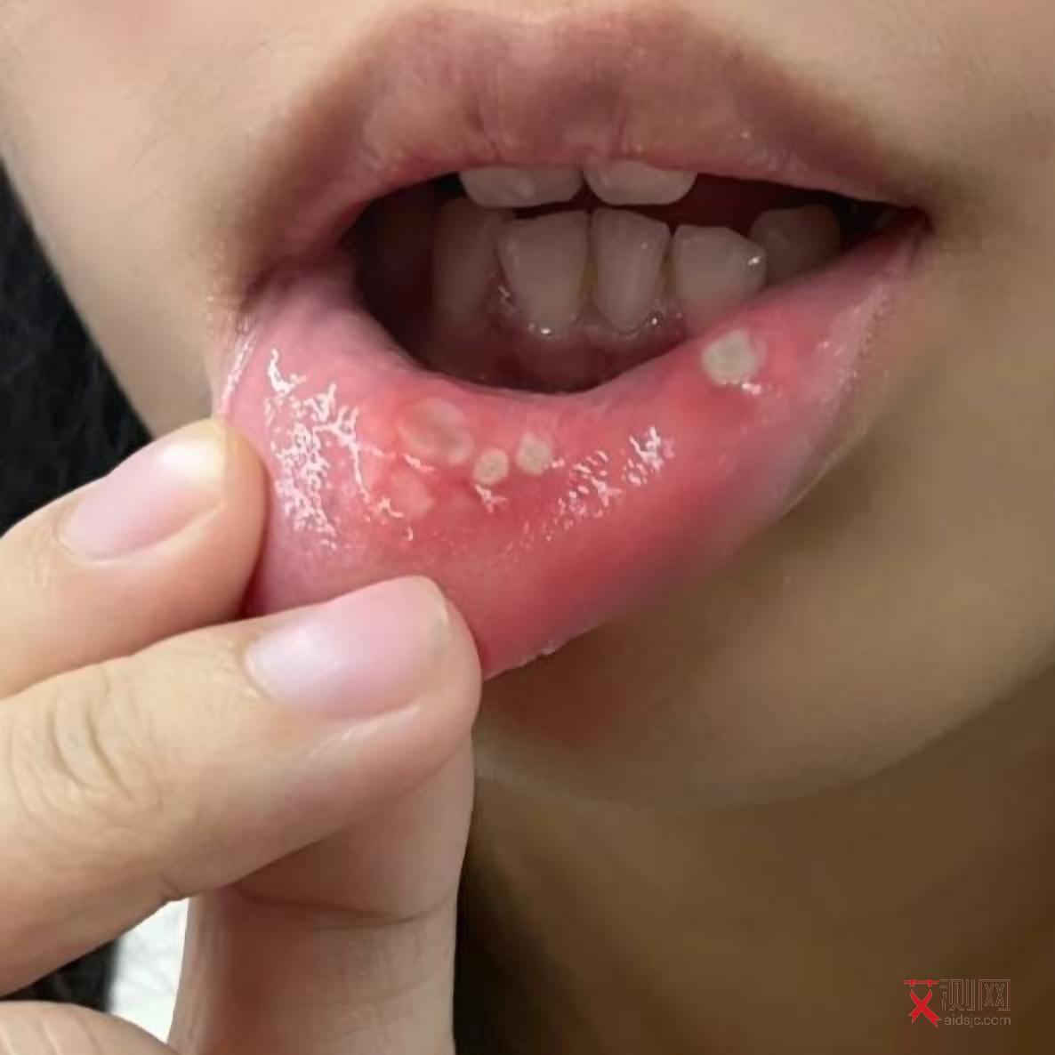 得了艾滋病皮疹图片真实