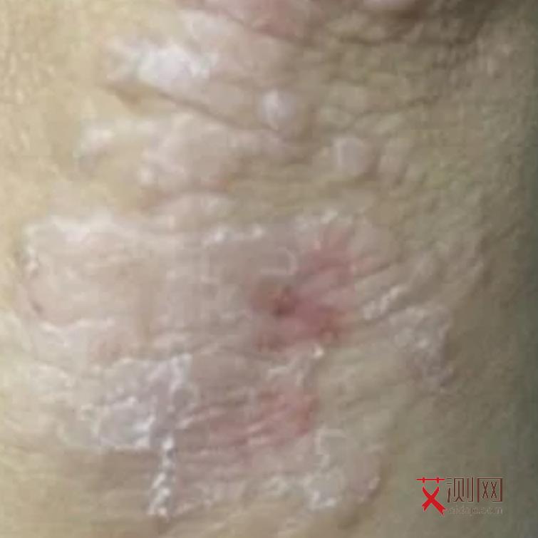 艾滋的早期口腔症状图片大全