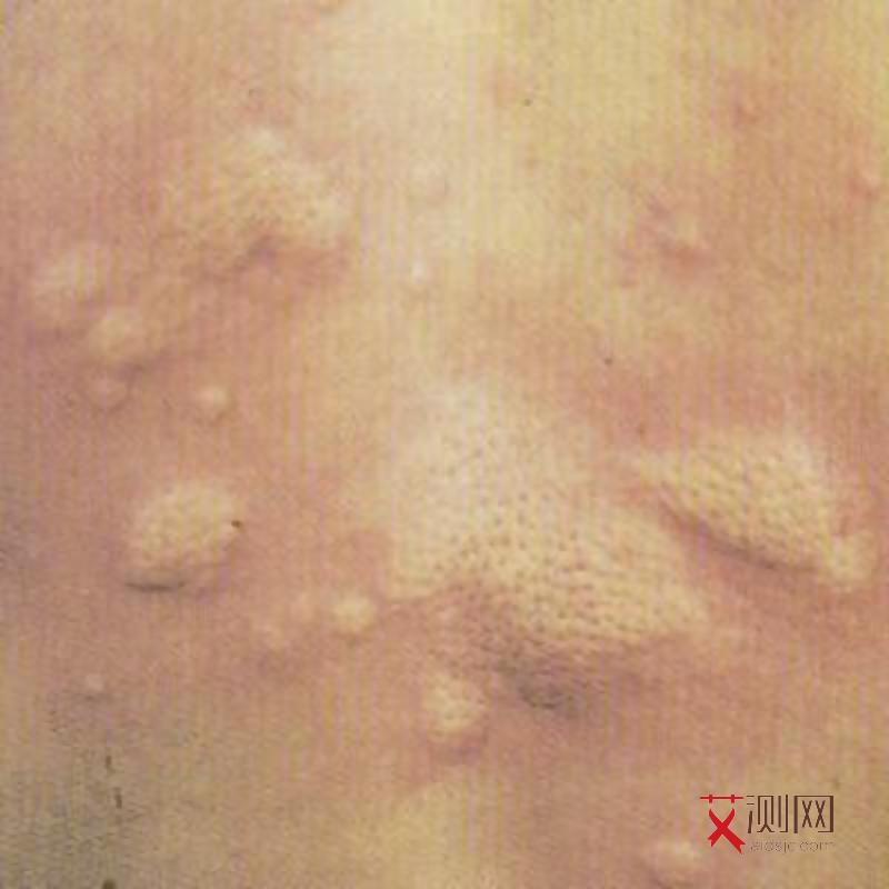 男性有艾滋病下体有什么症状图片