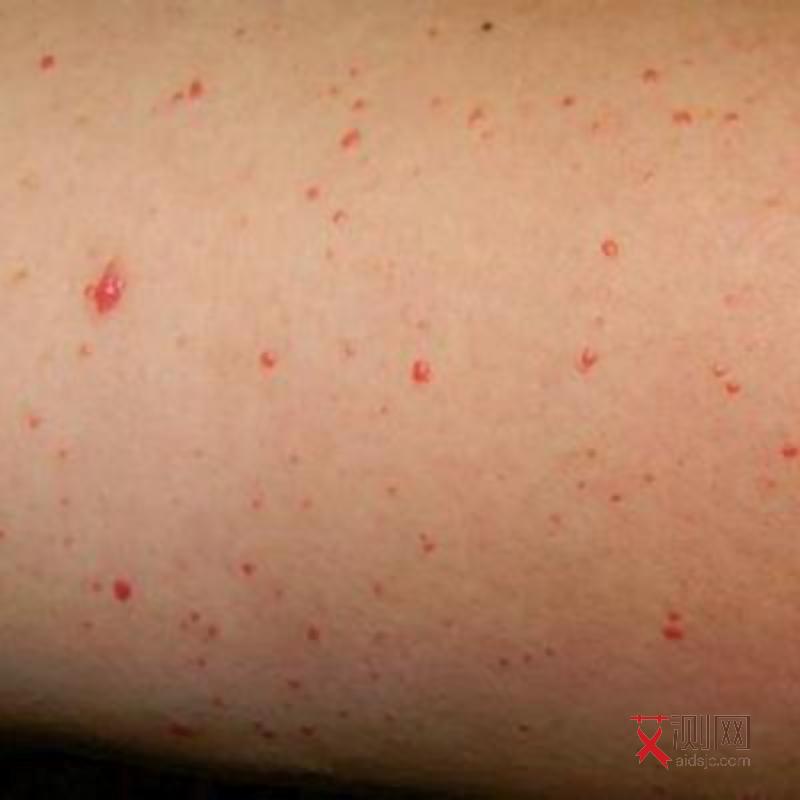 艾滋病人下体症状图片大全图解女性
