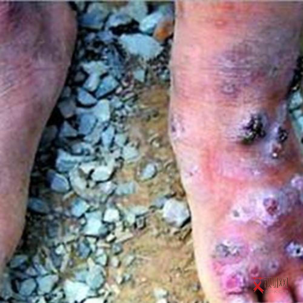 女性艾滋皮肤有哪些征兆呢