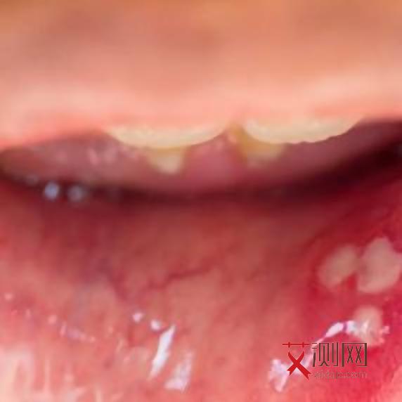 艾滋病患者会痒吗？