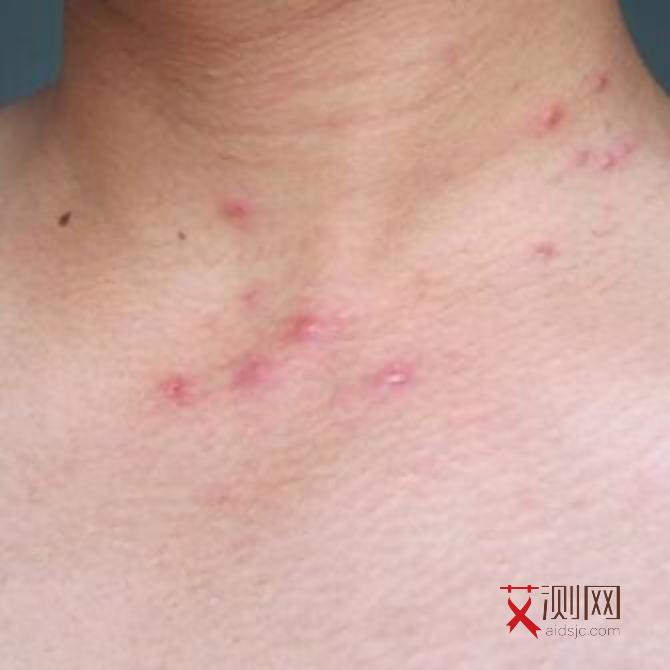 怎样检查自己有没有得艾滋病毒