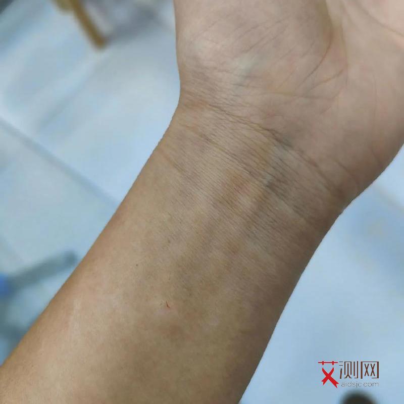 艾滋病前兆什么症状