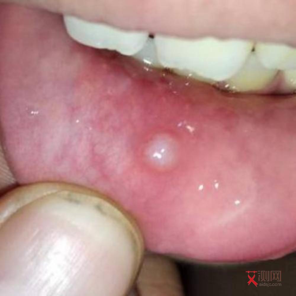 艾滋病得病几率表