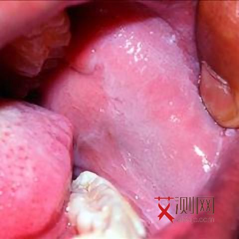 艾滋病症状很多为何6个月检测一直阴性