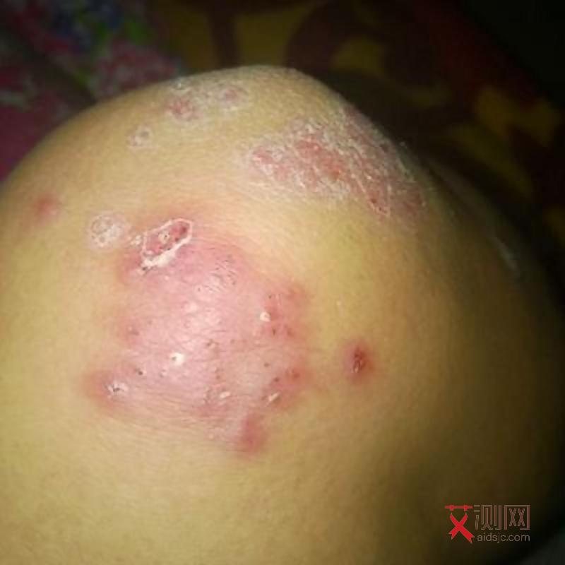 艾滋病一般有几个症状表现出来的