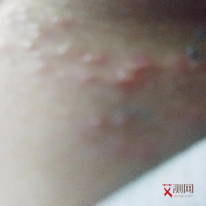 腋下溃烂是艾滋病初期症状吗会传染吗