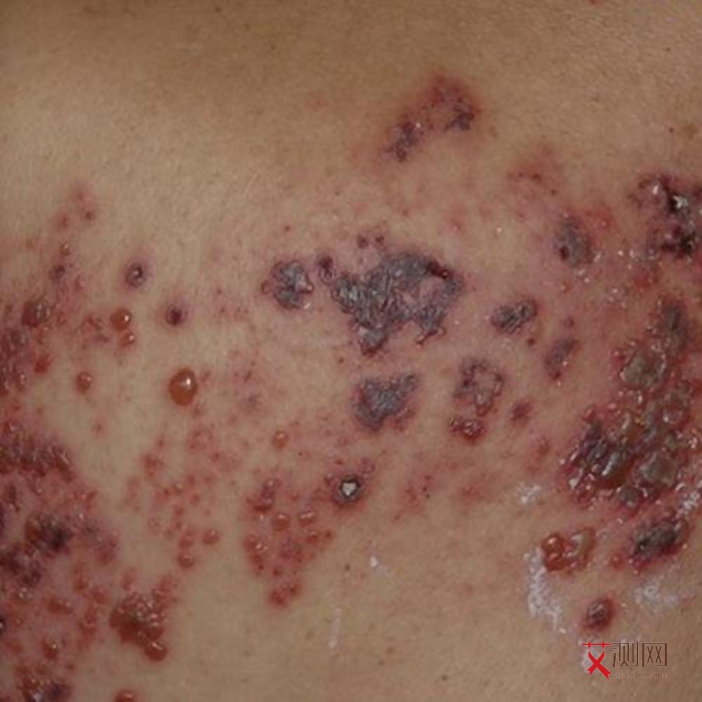 女性艾滋病前期有什么特征