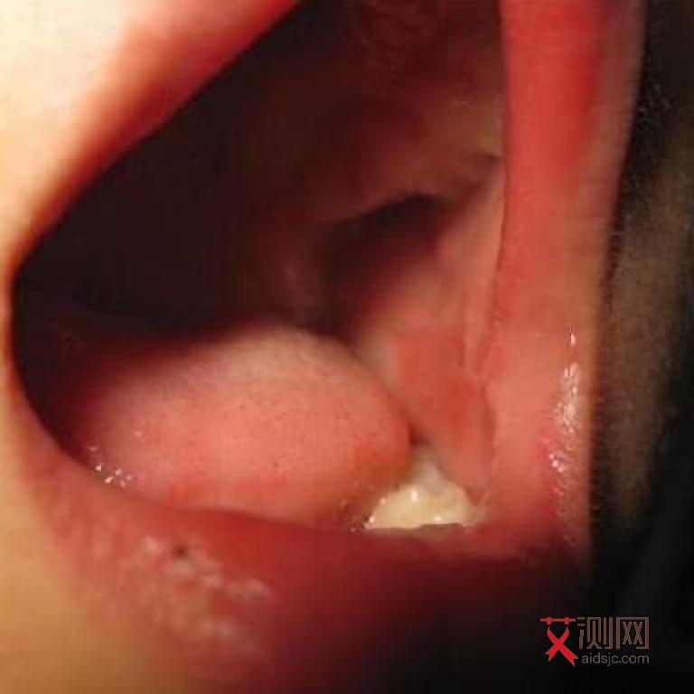 艾滋病一般有几个症状表现出来的