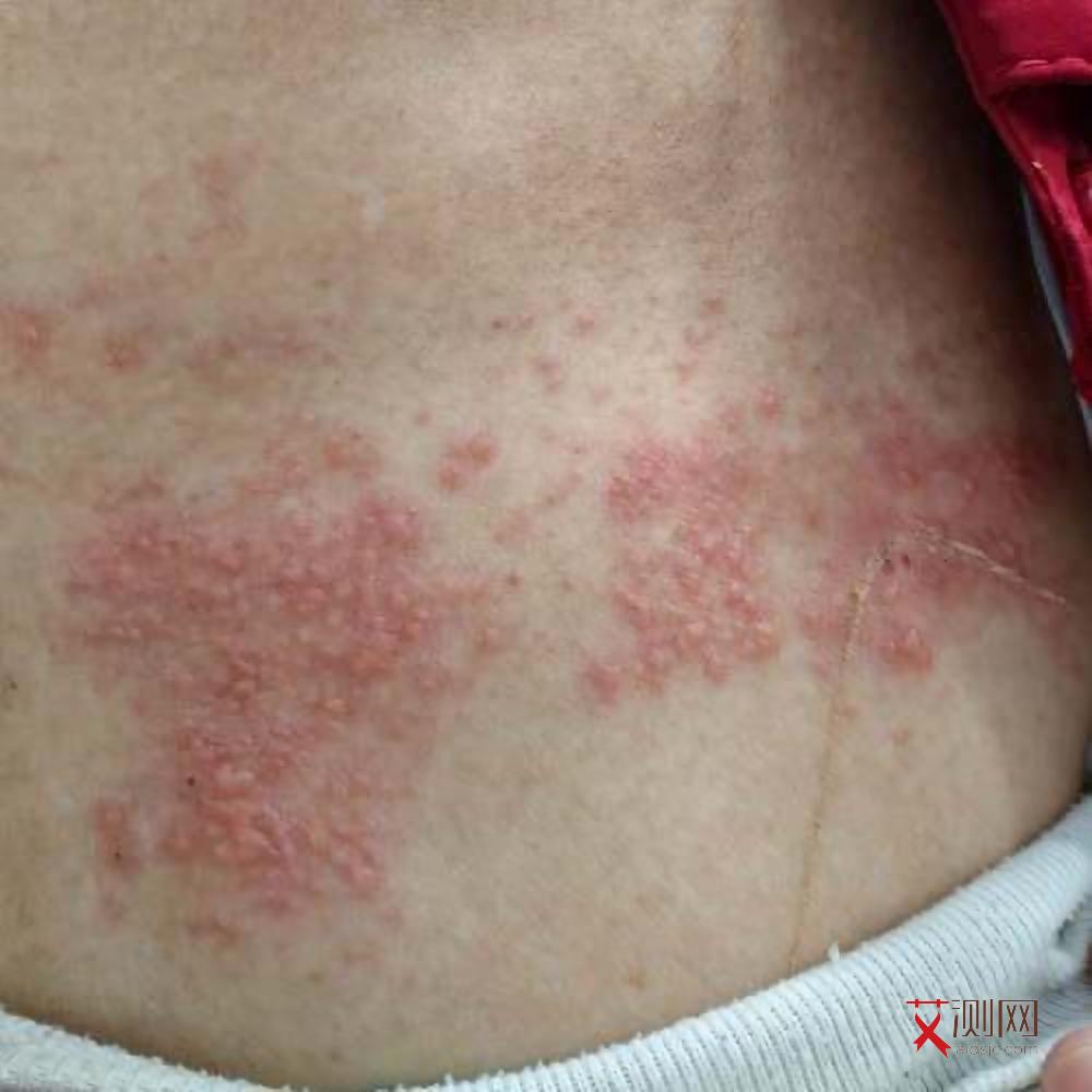 女性艾滋病有什么特征和症状