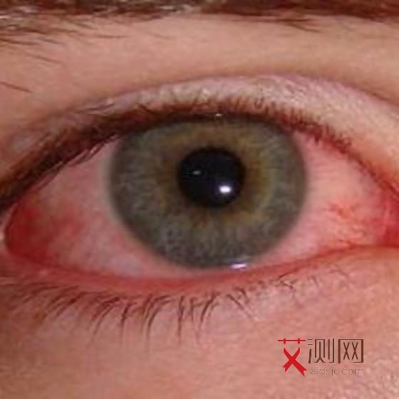 艾滋病有症状要多久才能发现出现症状