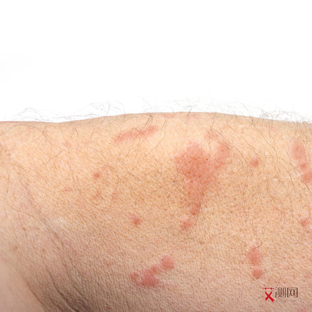 女人艾滋病多久有反应啊症状表现呢