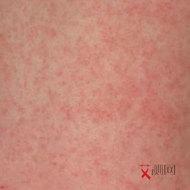 艾滋病前兆什么症状