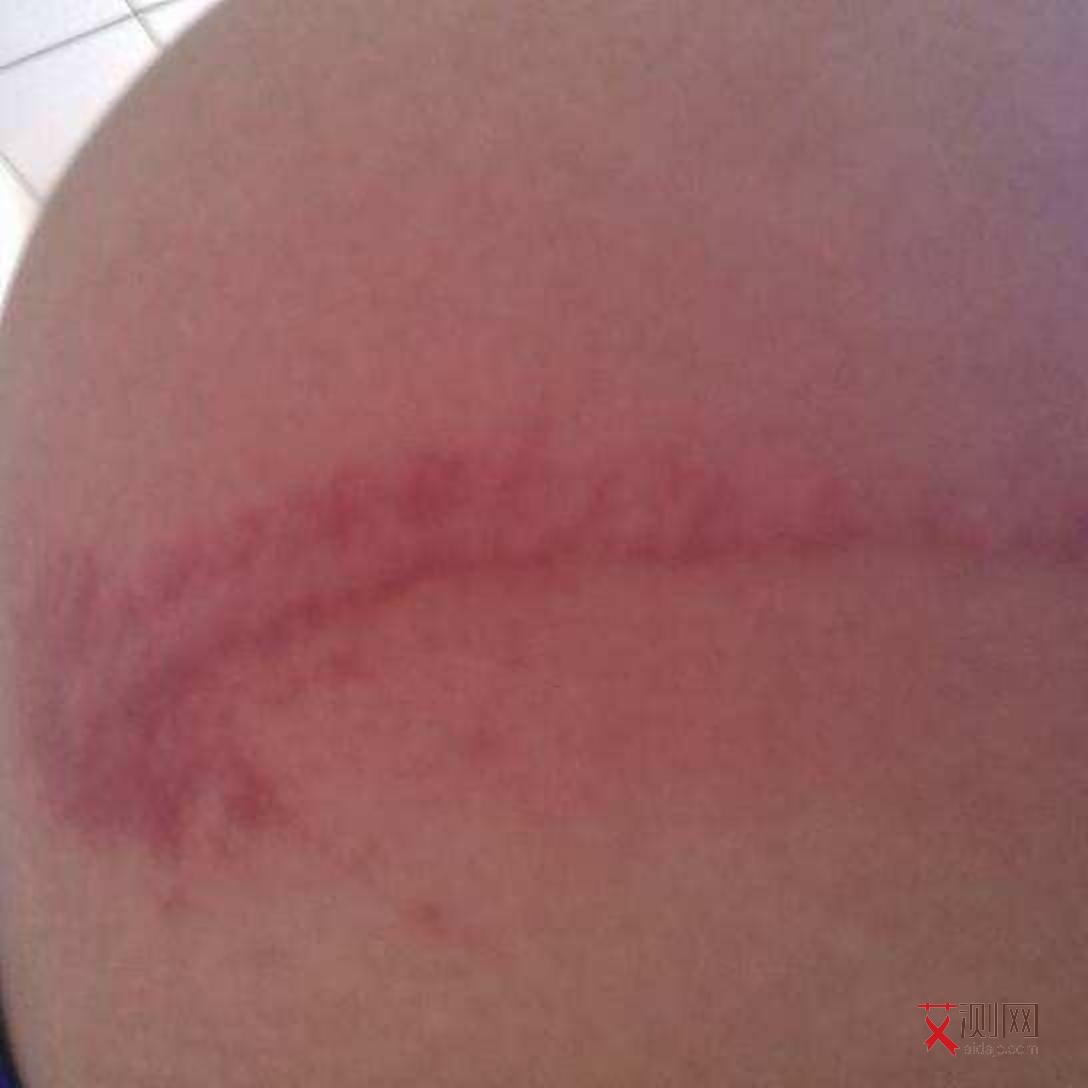 艾滋病前期会有小红点吗会传染吗女性