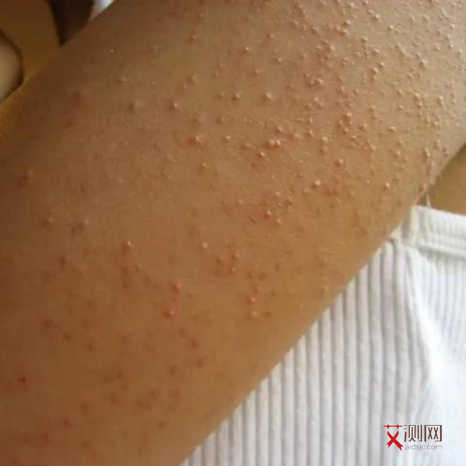 感染艾滋病现在有治疗办法没