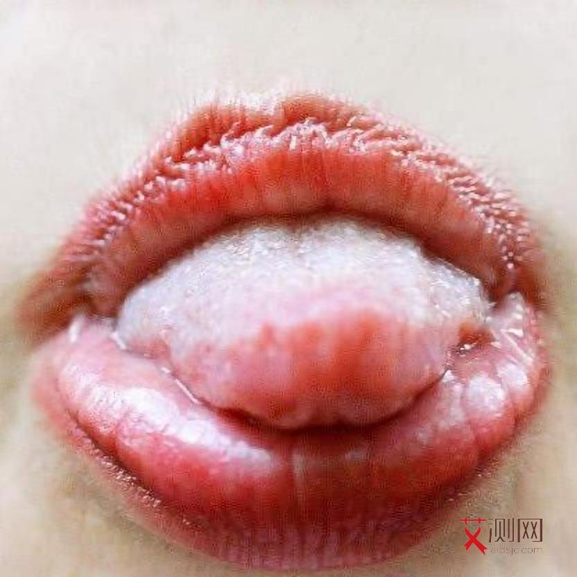 艾滋病和结核病的特征