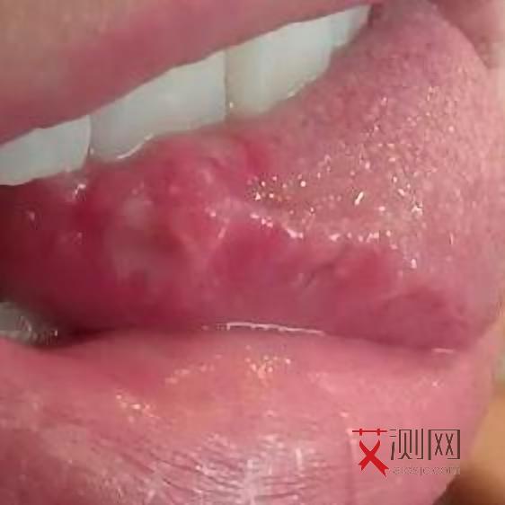 艾滋初期长的痘什么样