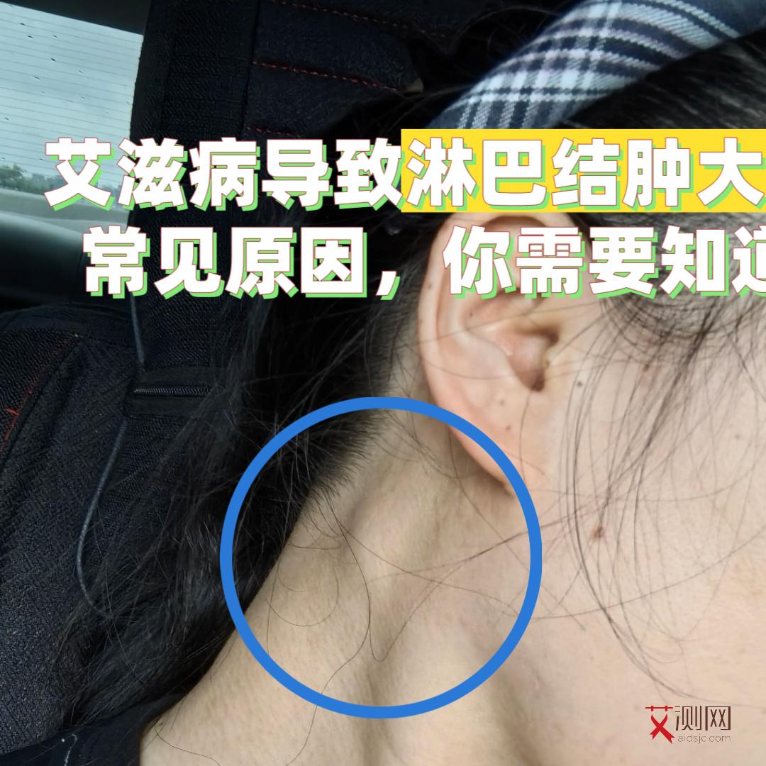 有艾滋病的症状但检查结果为阴性