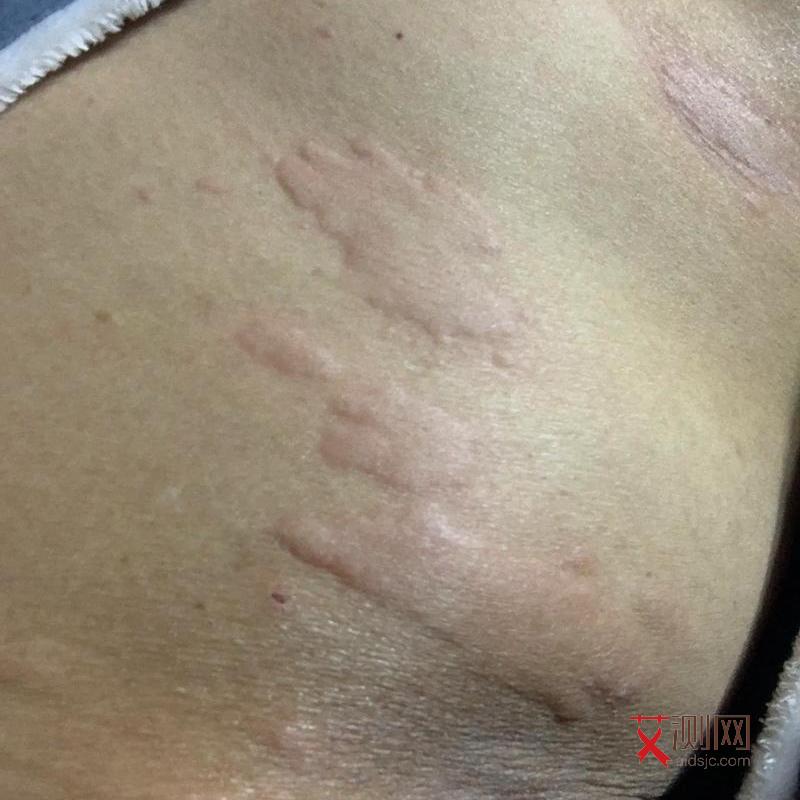 艾滋病皮疹症状图片对比图大全