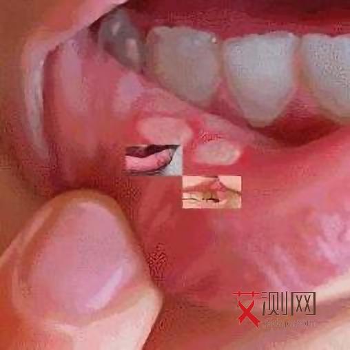 艾滋病皮肤溃疡用赛霉安散有用吗会传染吗