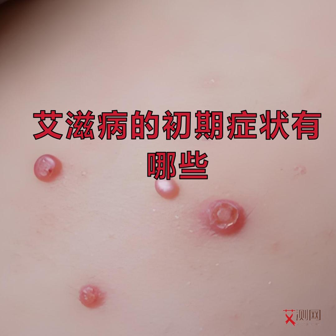 艾滋的临床表现不包括