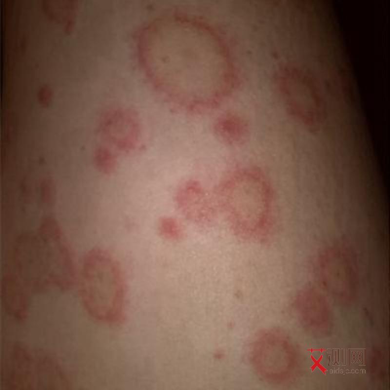 艾滋病初期最常见的症状有哪些男性