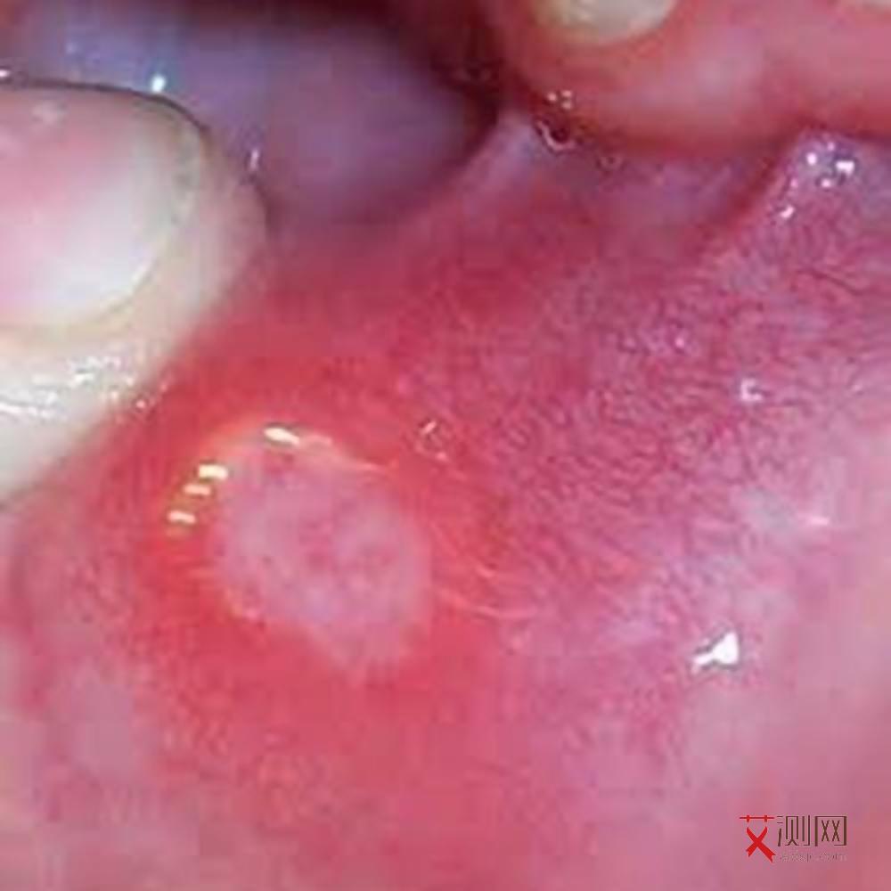 男性艾滋病症状是什么样子的图片