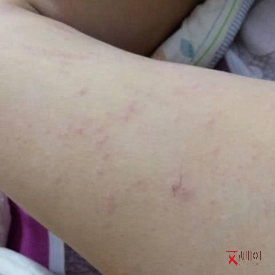 艾滋病有什么样的反应