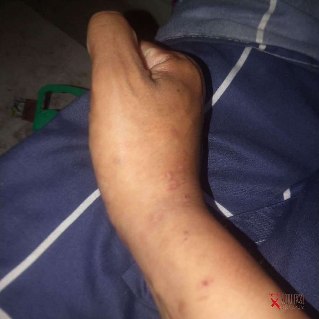 艾滋病有症状可以检测出来吗会传染吗