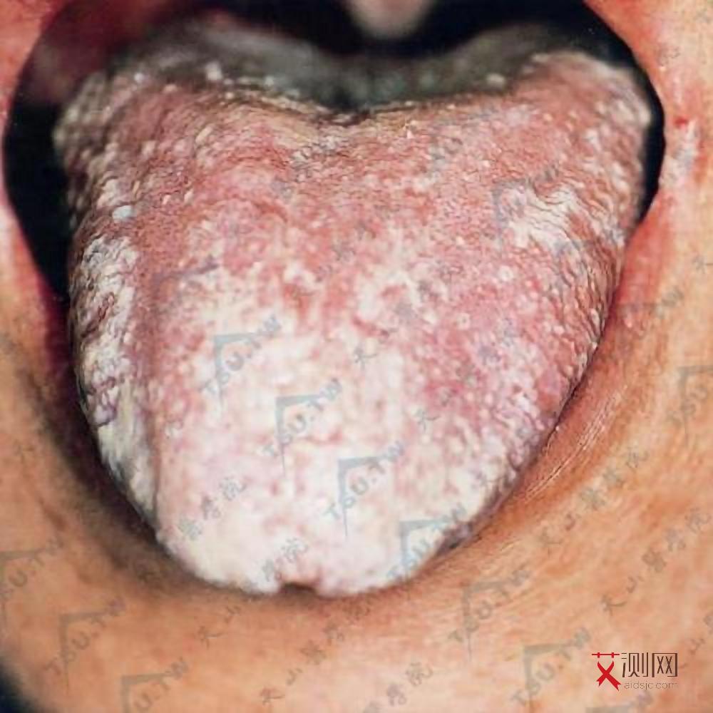 女性艾滋病下体有什么症状和症状图片