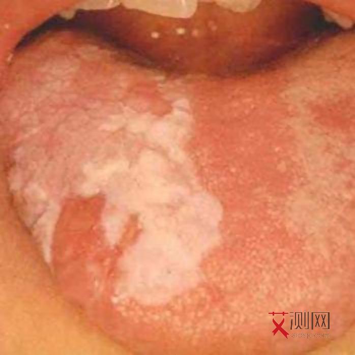 女性艾滋病患者照片