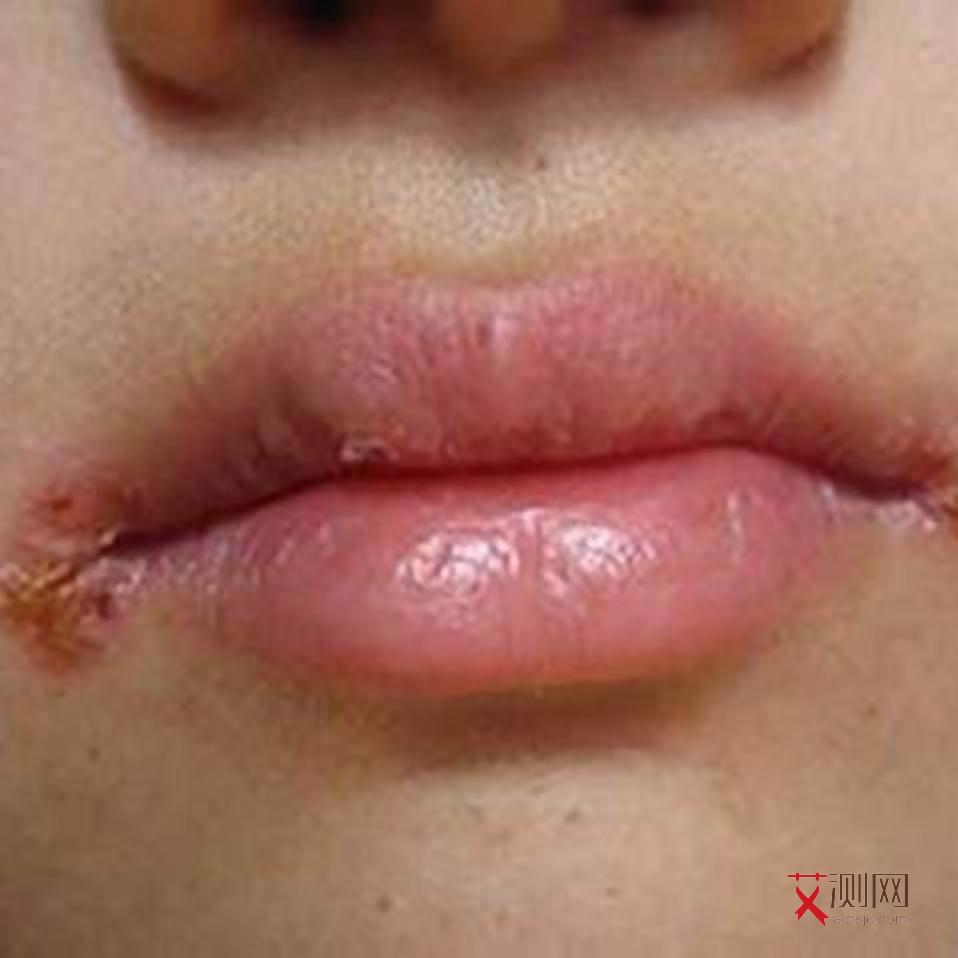 艾滋病下体有味道吗女性会传染吗