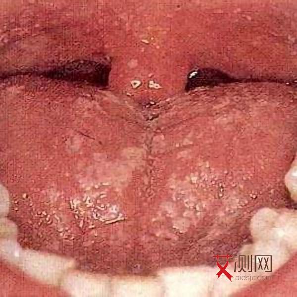 艾滋病人的唾液会不会传染给他人