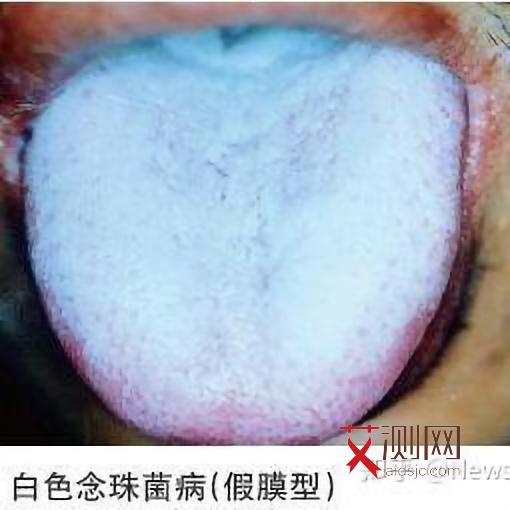 艾滋病男性的症状和表现