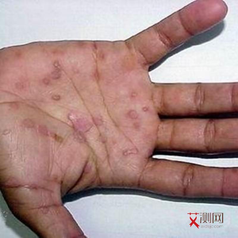 艾滋病口腔检测试纸准确率是多少