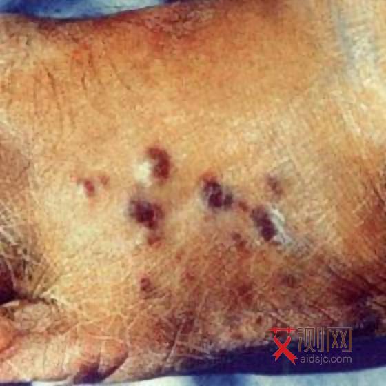 艾滋病的皮疹症状是什么样