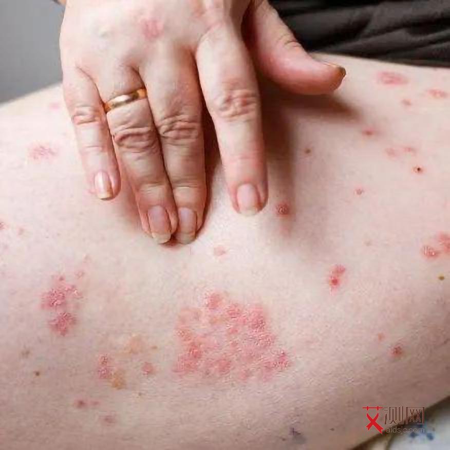 艾滋病长期咳嗽是什么样子的