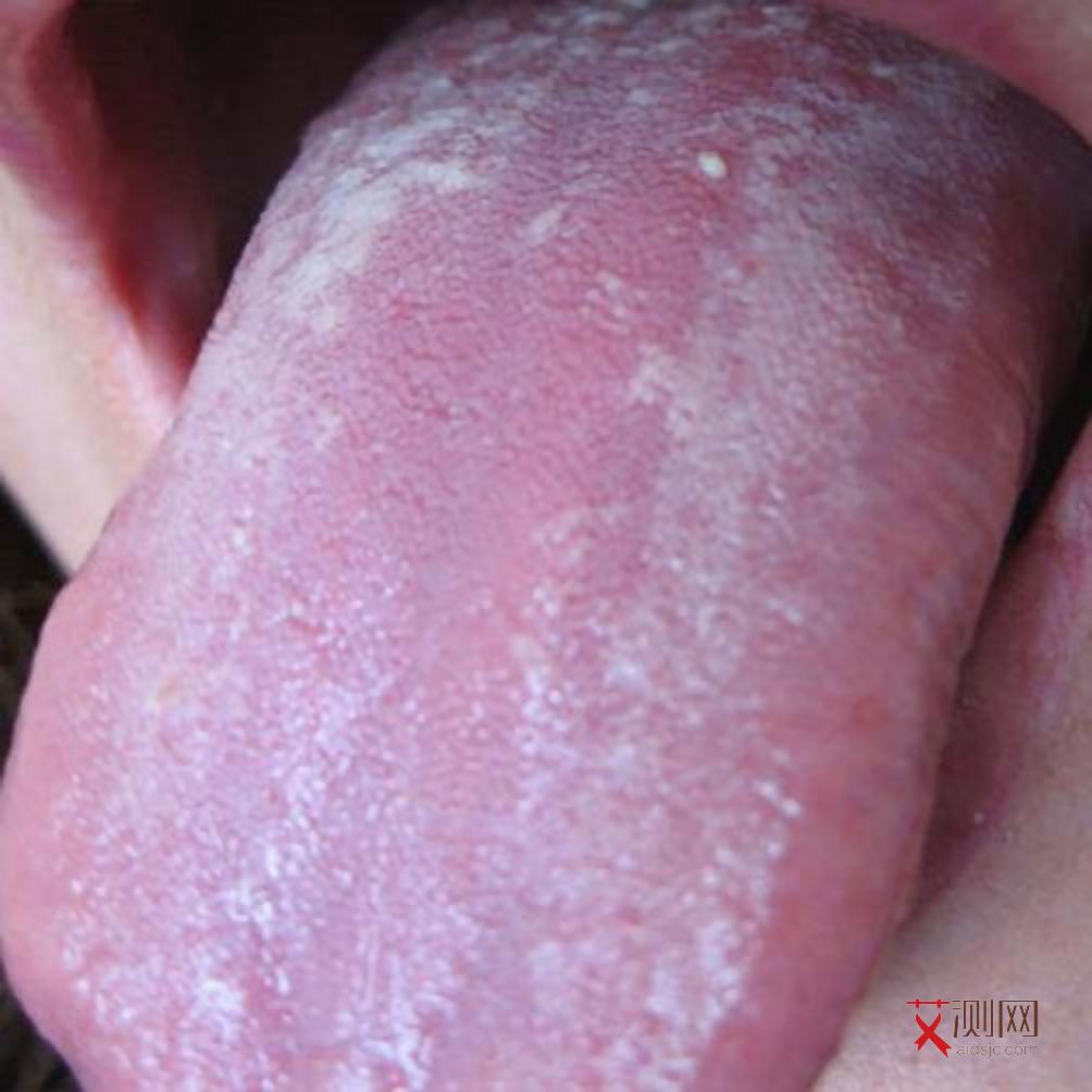 高危之后多久查艾滋梅毒